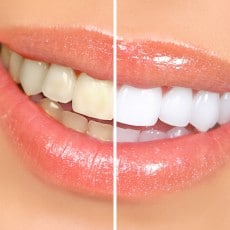 the-good-and-bad-of-teeth-whitening