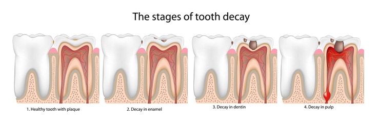 can-tooth-decay-be-reversed