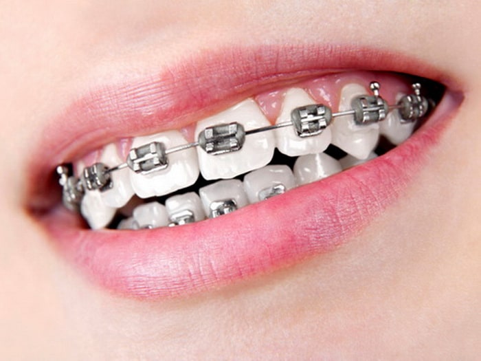 caring-for-your-teeth-when-wearing-braces