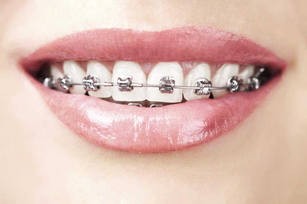 the-history-of-braces